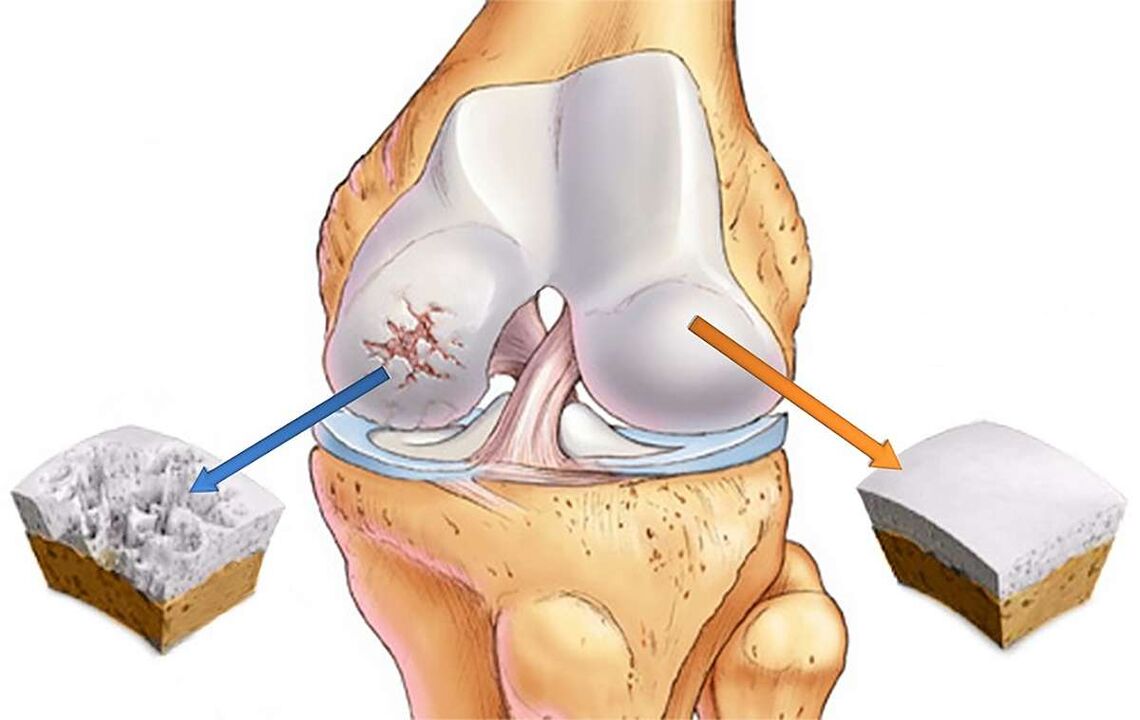 Destrucción del cartílago de la articulación de la rodilla con gonartrosis. 