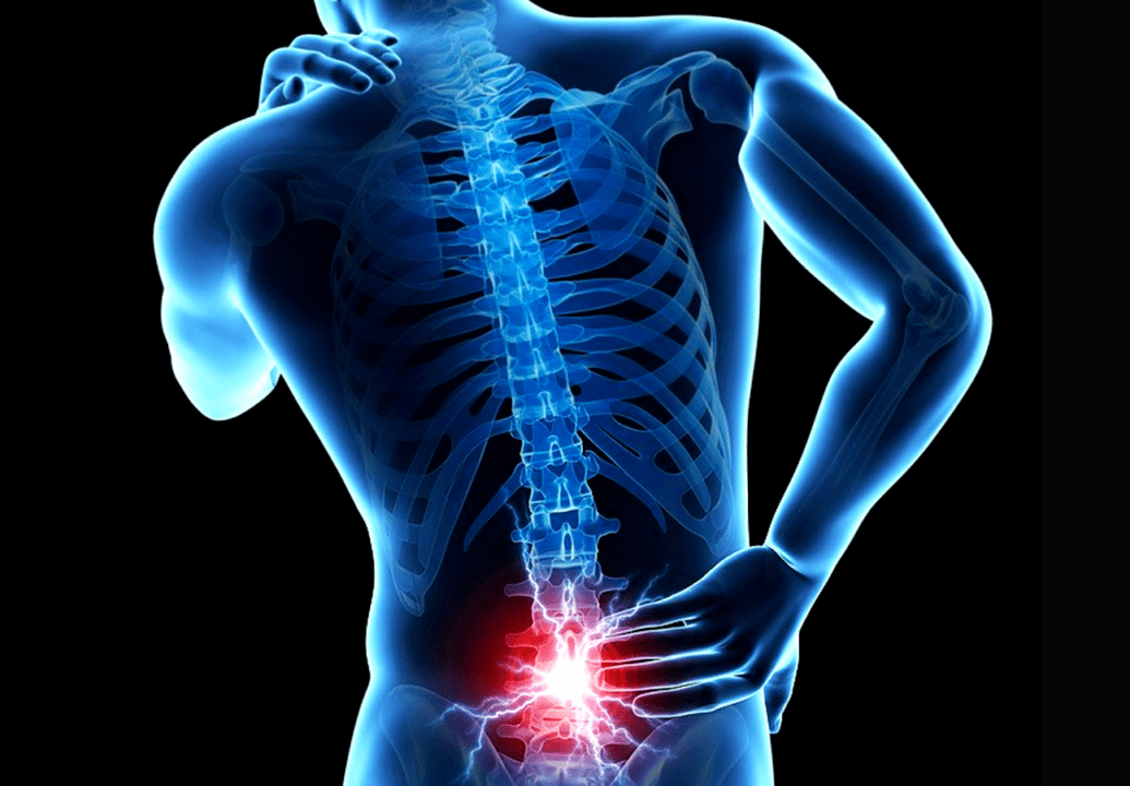 Signos de osteocondrosis lumbar. 