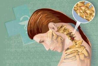 Síntomas reflejos de una osteocondrosis de cuello