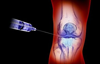El plan de tratamiento para la osteoartritis de la articulación de la rodilla