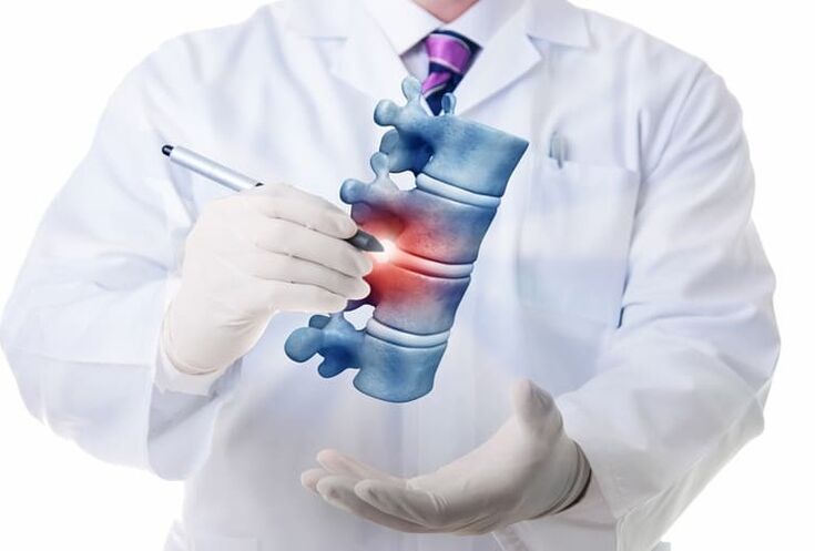 Lesiones de la columna por osteocondrosis torácica.