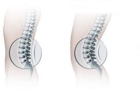 Columna normal y aumento de la lordosis lumbar.