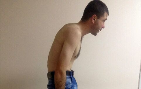 La espondilitis anquilosante puede provocar dolor lumbar con el paso de los años