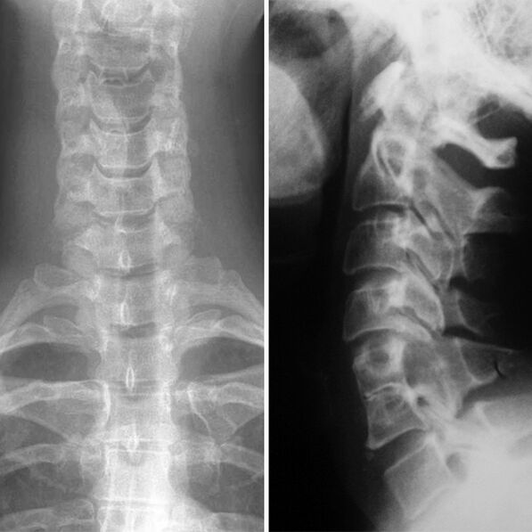 Radiografía de la columna cervical.